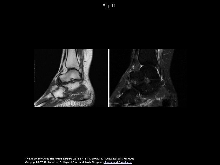 Fig. 11 The Journal of Foot and Ankle Surgery 2018 57131 -139 DOI: (10.