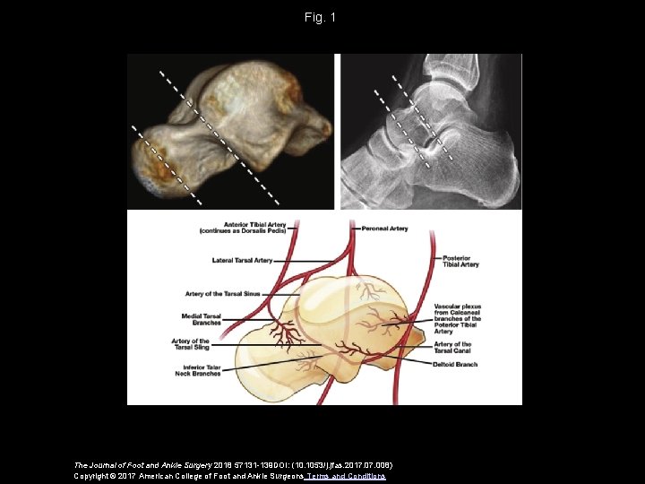 Fig. 1 The Journal of Foot and Ankle Surgery 2018 57131 -139 DOI: (10.