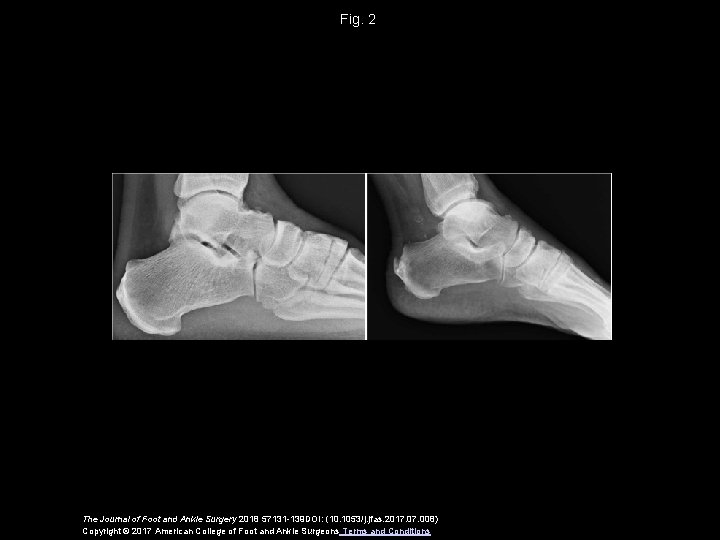 Fig. 2 The Journal of Foot and Ankle Surgery 2018 57131 -139 DOI: (10.