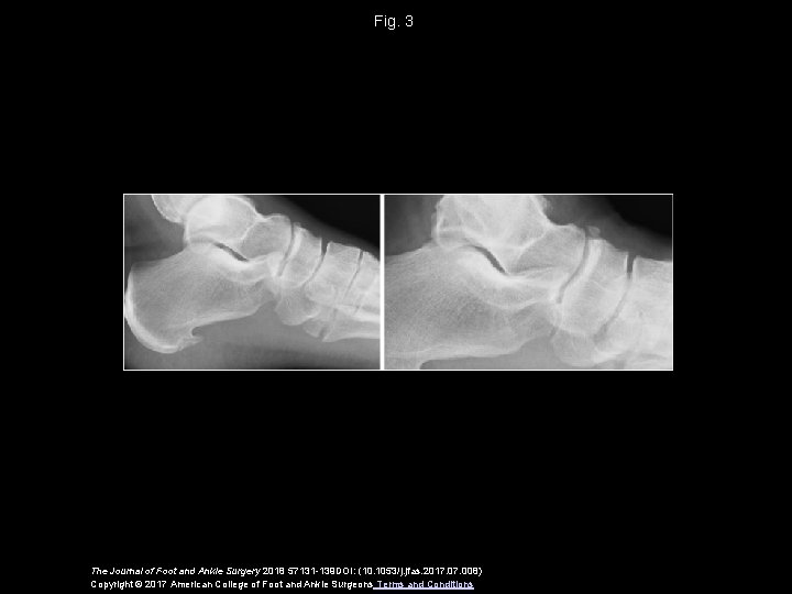 Fig. 3 The Journal of Foot and Ankle Surgery 2018 57131 -139 DOI: (10.