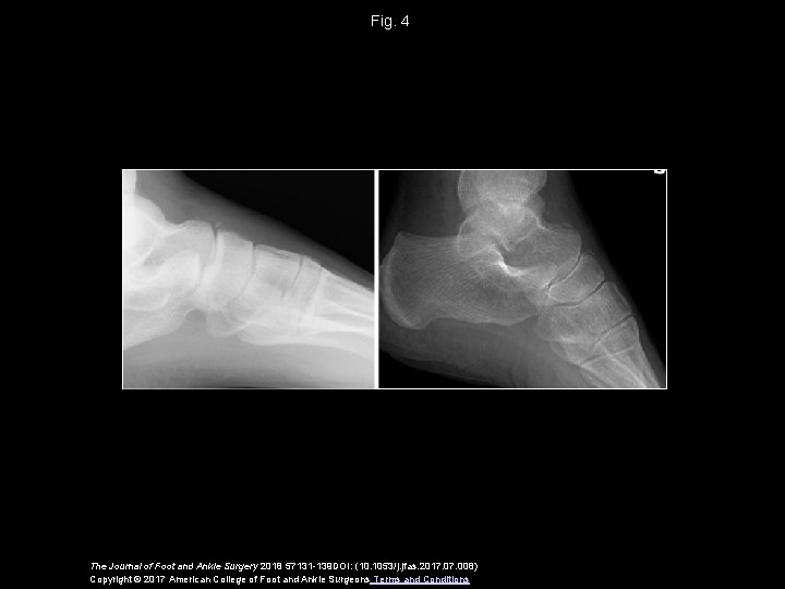 Fig. 4 The Journal of Foot and Ankle Surgery 2018 57131 -139 DOI: (10.