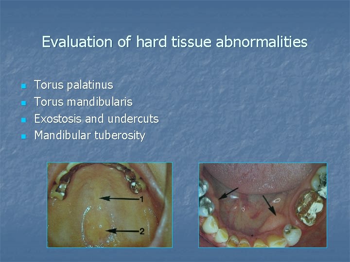 Evaluation of hard tissue abnormalities n n Torus palatinus Torus mandibularis Exostosis and undercuts