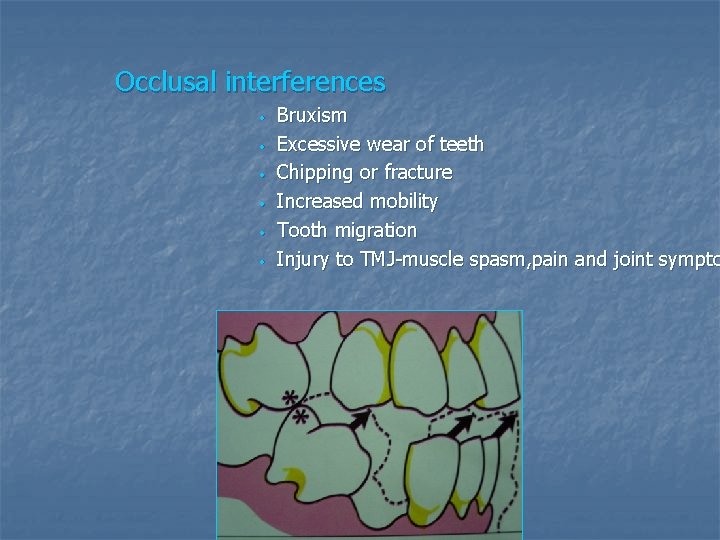 Occlusal interferences • • • Bruxism Excessive wear of teeth Chipping or fracture Increased