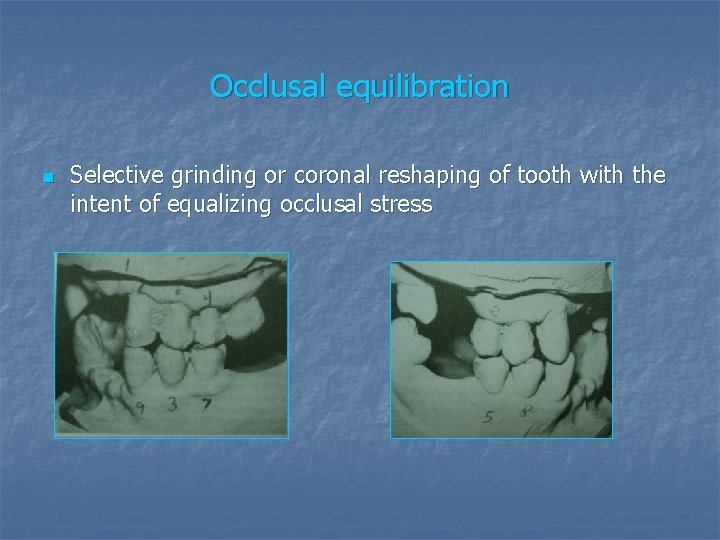 Occlusal equilibration n Selective grinding or coronal reshaping of tooth with the intent of