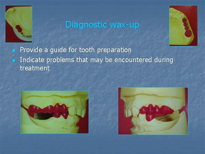 Diagnostic wax-up n n Provide a guide for tooth preparation Indicate problems that may