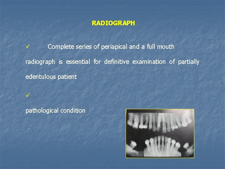 RADIOGRAPH ü Complete series of periapical and a full mouth radiograph is essential for