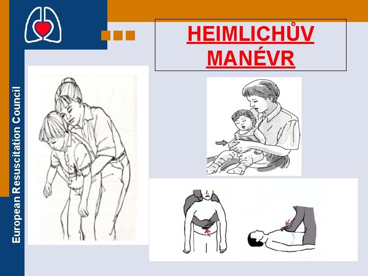 European Resuscitation Council HEIMLICHŮV MANÉVR 