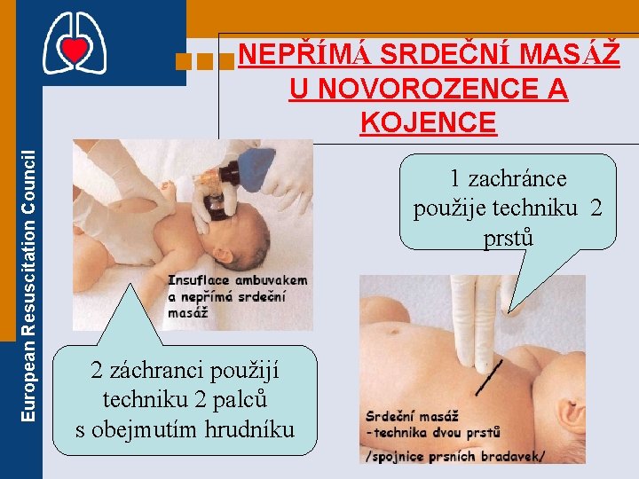 European Resuscitation Council NEPŘÍMÁ SRDEČNÍ MASÁŽ U NOVOROZENCE A KOJENCE 1 zachránce použije techniku