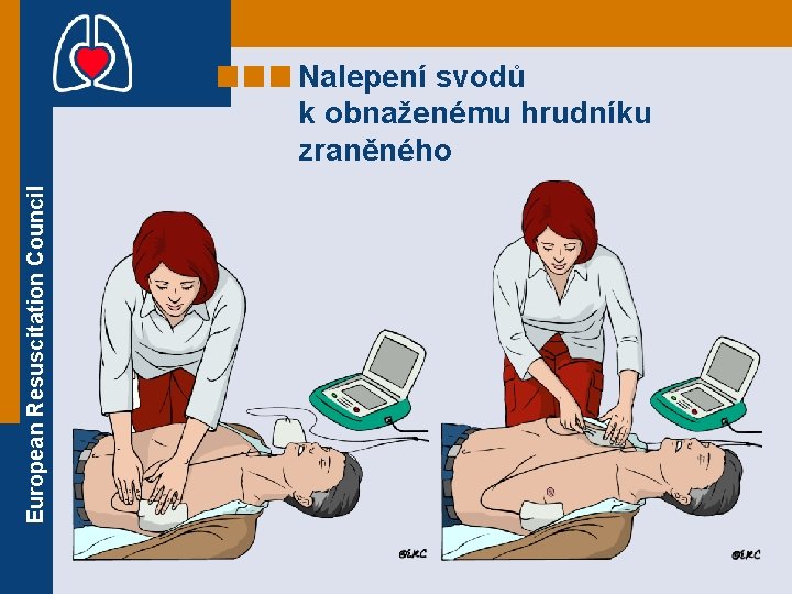 European Resuscitation Council Nalepení svodů k obnaženému hrudníku zraněného 