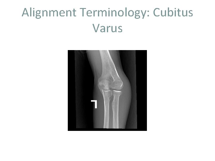 Alignment Terminology: Cubitus Varus 