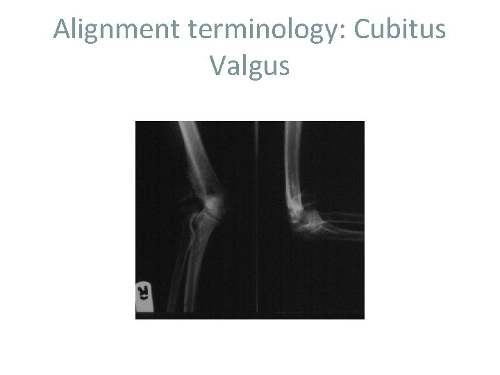 Alignment terminology: Cubitus Valgus 