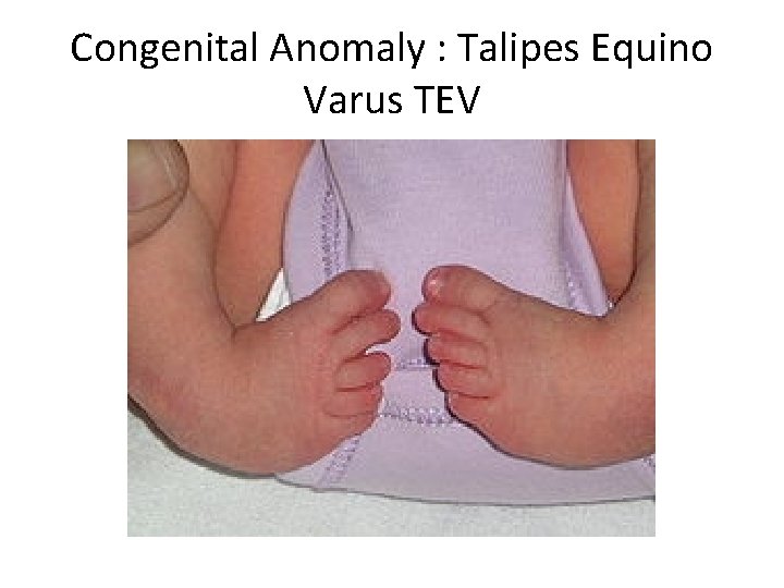 Congenital Anomaly : Talipes Equino Varus TEV 