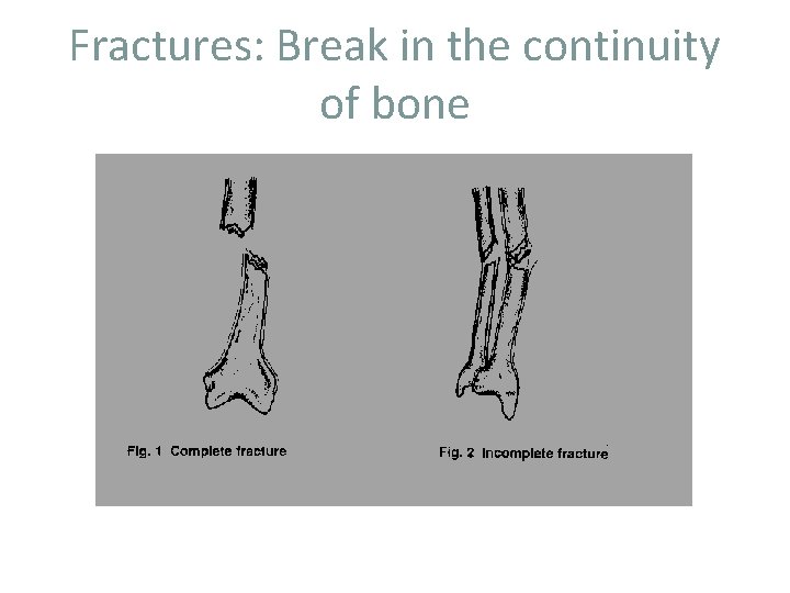 Fractures: Break in the continuity of bone 