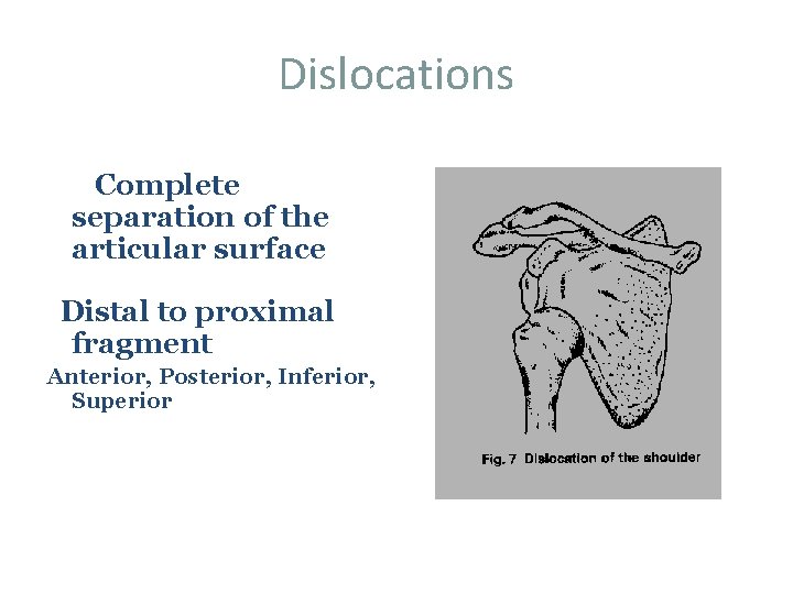 Dislocations Complete separation of the articular surface Distal to proximal fragment Anterior, Posterior, Inferior,