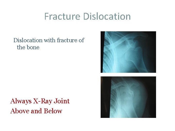 Fracture Dislocation with fracture of the bone Always X-Ray Joint Above and Below 
