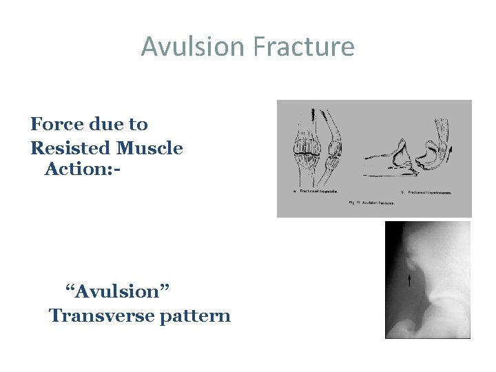 Avulsion Fracture Force due to Resisted Muscle Action: - “Avulsion” Transverse pattern 