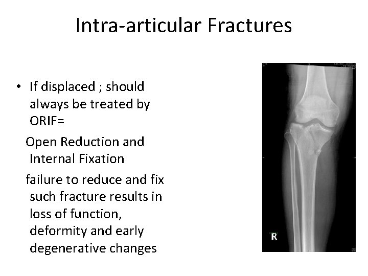 Intra articular Fractures • If displaced ; should always be treated by ORIF= Open