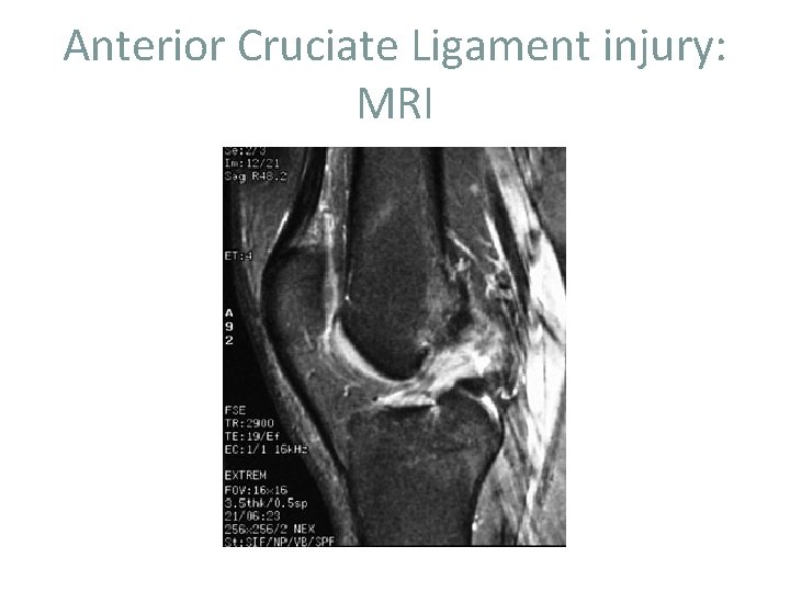 Anterior Cruciate Ligament injury: MRI 