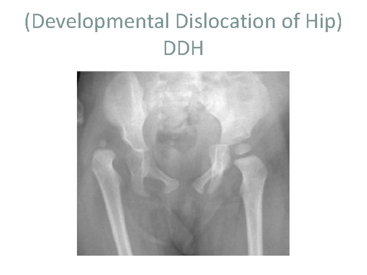 (Developmental Dislocation of Hip) DDH 