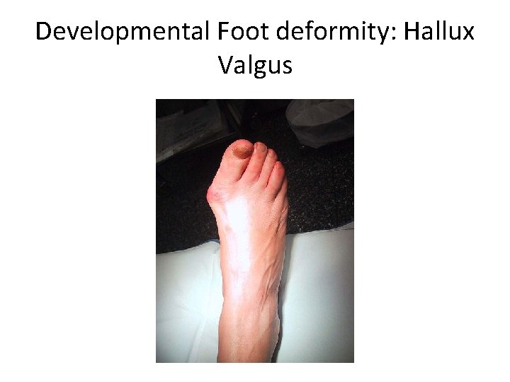 Developmental Foot deformity: Hallux Valgus 