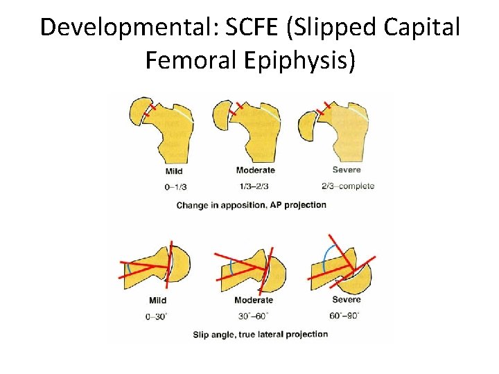 Developmental: SCFE (Slipped Capital Femoral Epiphysis) 