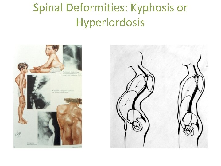 Spinal Deformities: Kyphosis or Hyperlordosis 