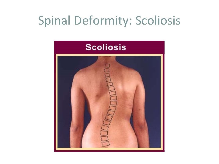 Spinal Deformity: Scoliosis 
