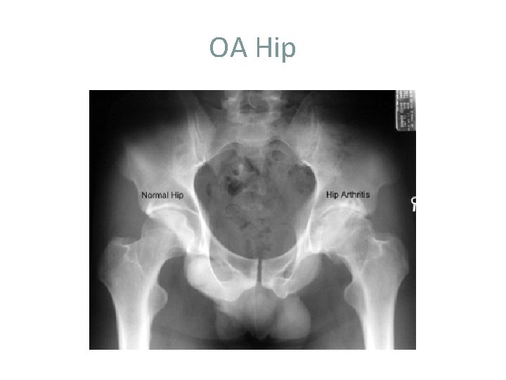 OA Hip 