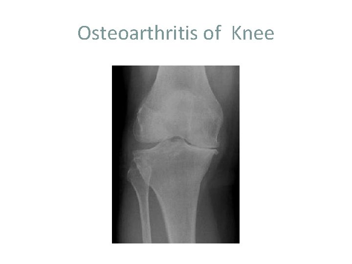 Osteoarthritis of Knee 