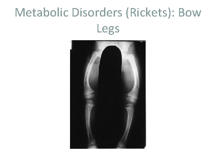 Metabolic Disorders (Rickets): Bow Legs 