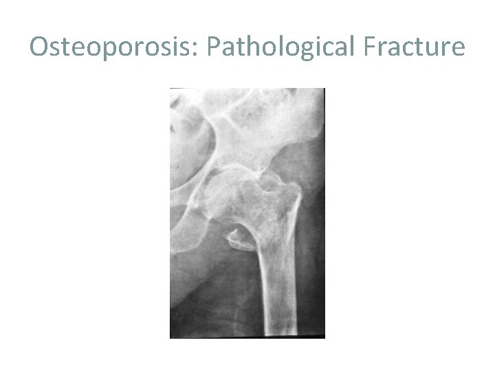 Osteoporosis: Pathological Fracture 