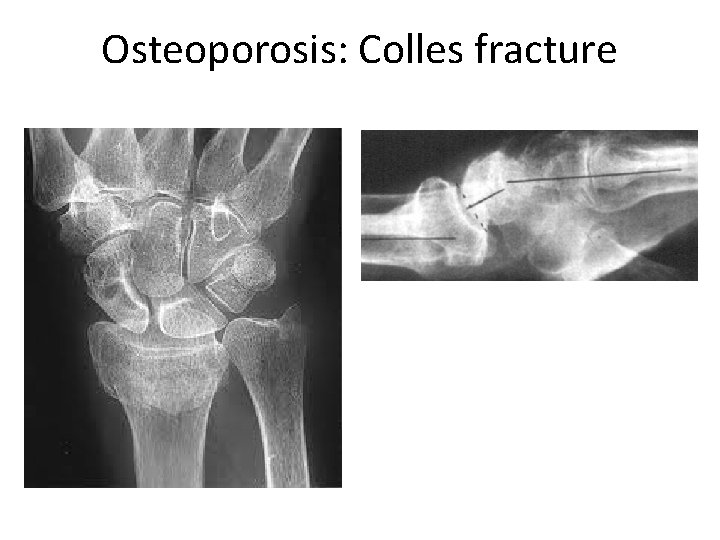 Osteoporosis: Colles fracture 