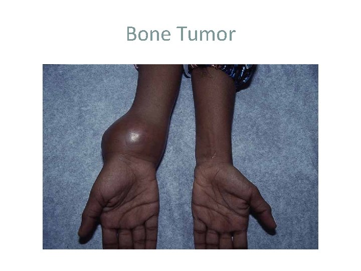 Bone Tumor 