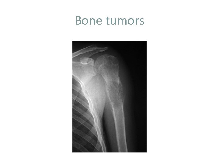 Bone tumors 