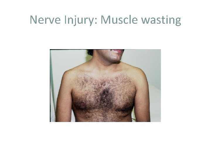 Nerve Injury: Muscle wasting 