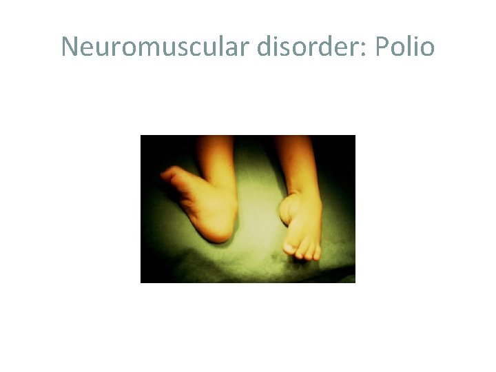 Neuromuscular disorder: Polio 