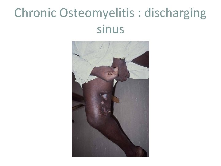 Chronic Osteomyelitis : discharging sinus 