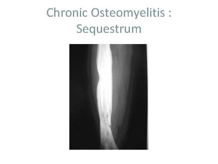 Chronic Osteomyelitis : Sequestrum 