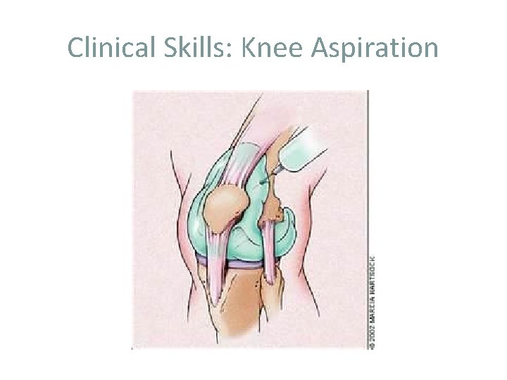 Clinical Skills: Knee Aspiration 