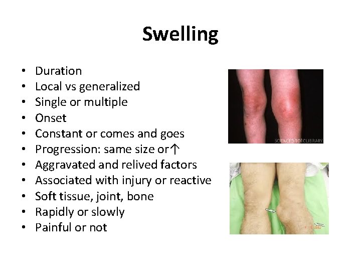 Swelling • • • Duration Local vs generalized Single or multiple Onset Constant or