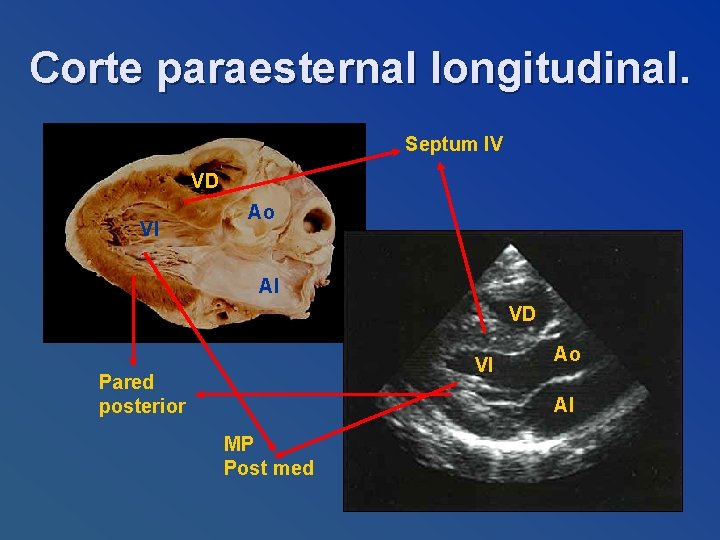Corte paraesternal longitudinal. Septum IV VD VI Ao AI VD VI Pared posterior Ao