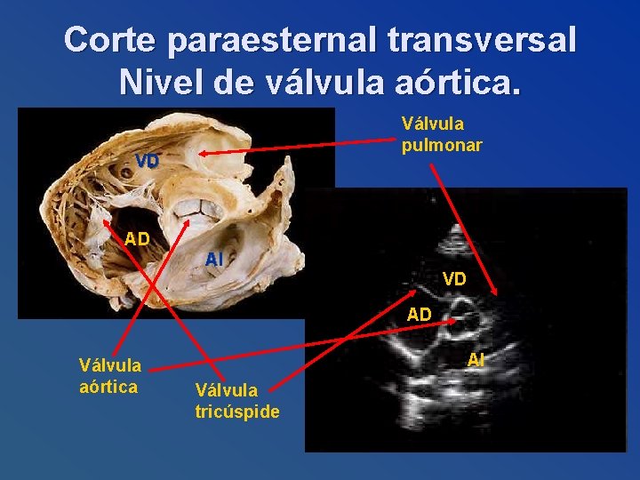 Corte paraesternal transversal Nivel de válvula aórtica. Válvula pulmonar VD AD AI VD AD