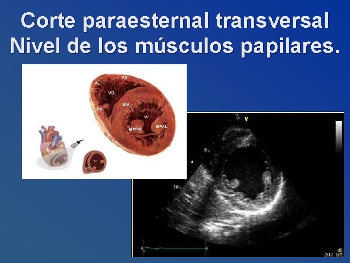 Corte paraesternal transversal Nivel de los músculos papilares. 