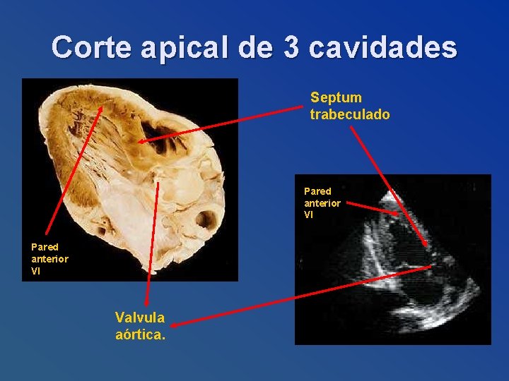 Corte apical de 3 cavidades Septum trabeculado Pared anterior VI Valvula aórtica. 