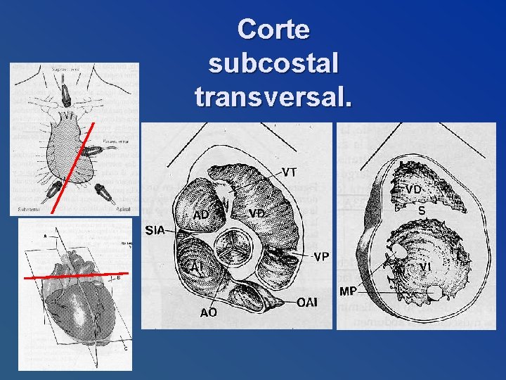 Corte subcostal transversal. 