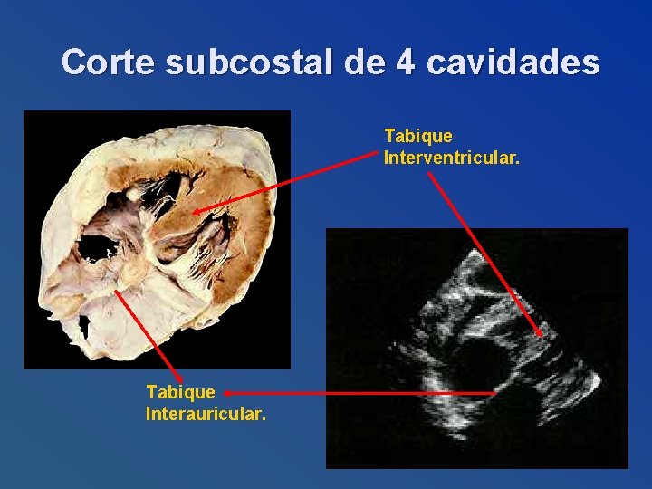Corte subcostal de 4 cavidades Tabique Interventricular. Tabique Interauricular. 