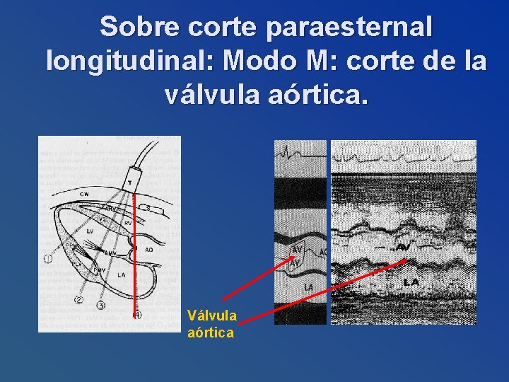 Sobre corte paraesternal longitudinal: Modo M: corte de la válvula aórtica. Válvula aórtica 
