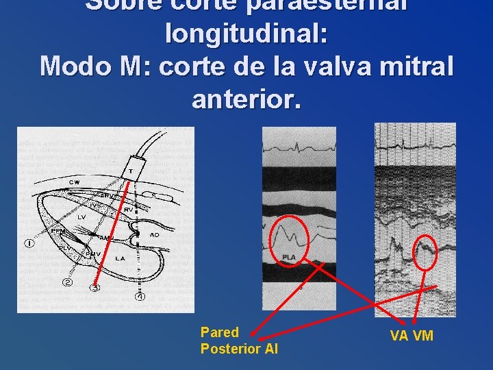 Sobre corte paraesternal longitudinal: Modo M: corte de la valva mitral anterior. Pared Posterior