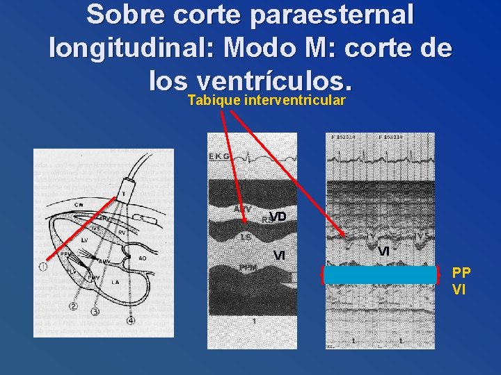 Sobre corte paraesternal longitudinal: Modo M: corte de los ventrículos. Tabique interventricular VD VI