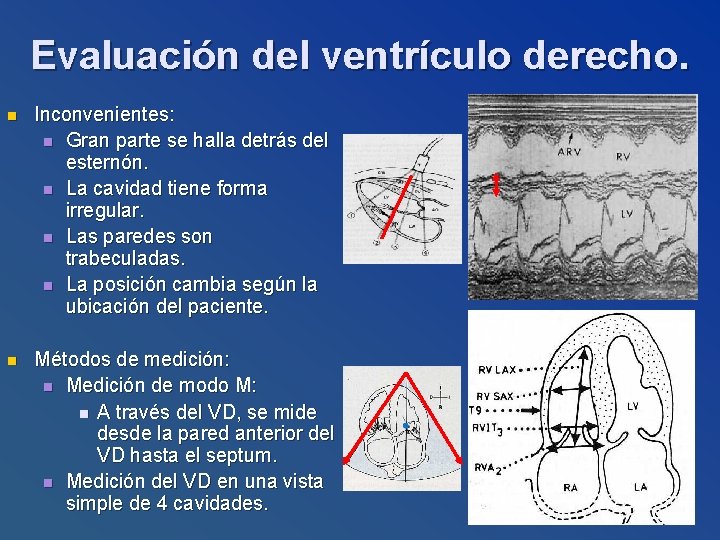 Evaluación del ventrículo derecho. n Inconvenientes: n Gran parte se halla detrás del esternón.